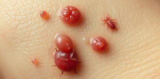 What Do Termite Bites Look Like? Signs and Symptoms what do termite bites look like